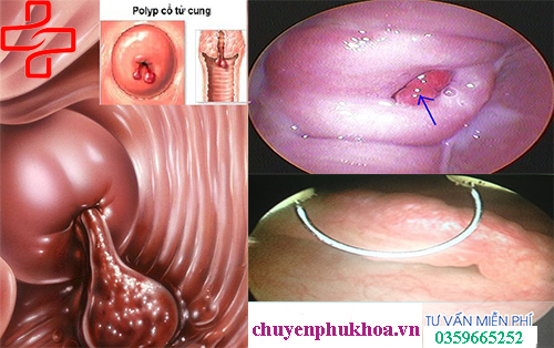 1 Hình ảnh polyp cổ tử cung và cách chữa an toàn