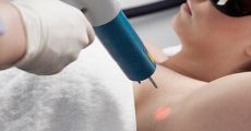 chi phí trị hôi nách bằng laser